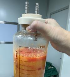 平湖水动力吸脂手术要做多久？